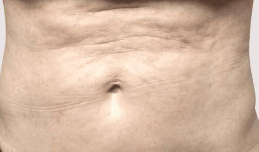 Lumpiness and scarring after lipo