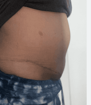 tummy tuck scar