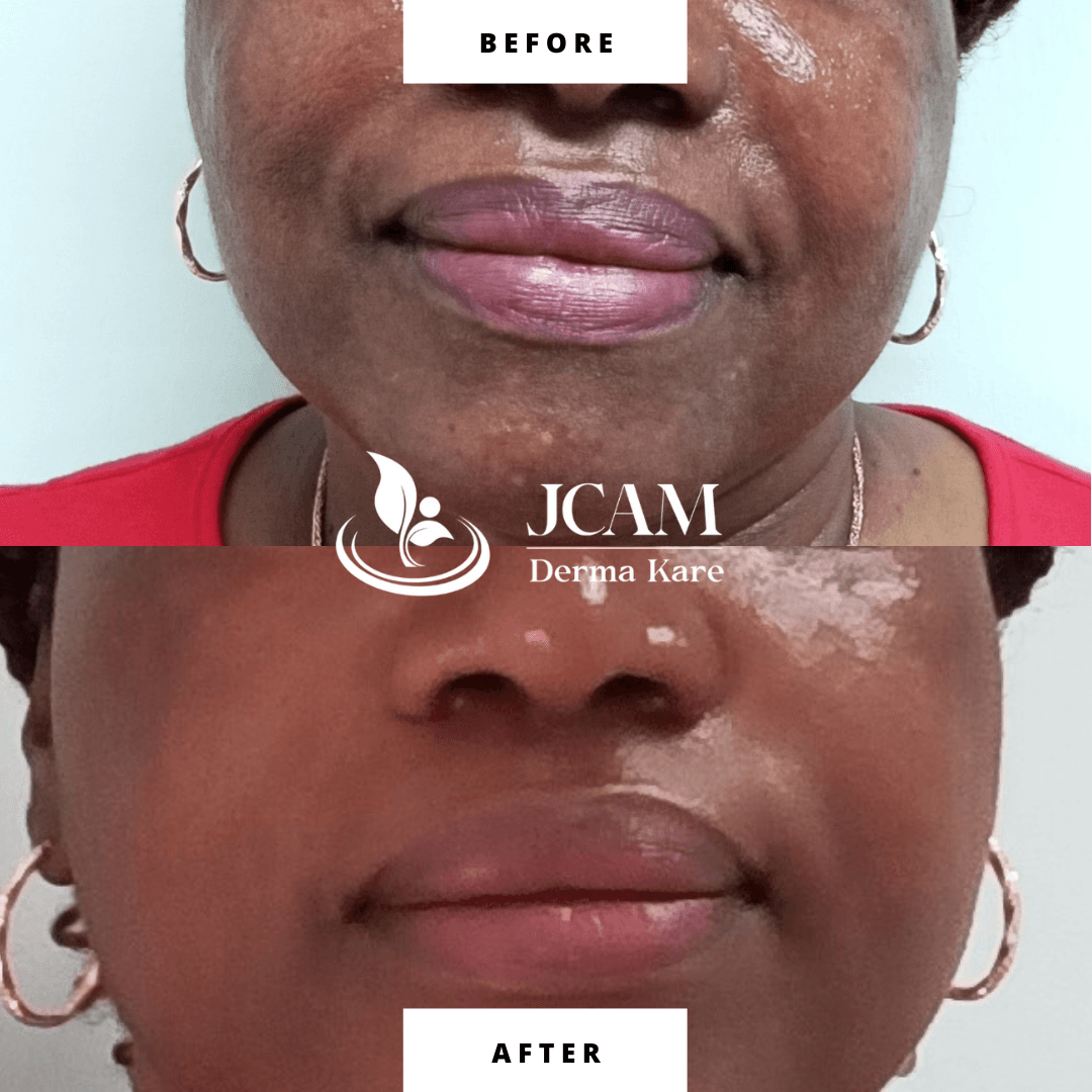 before and after fillers