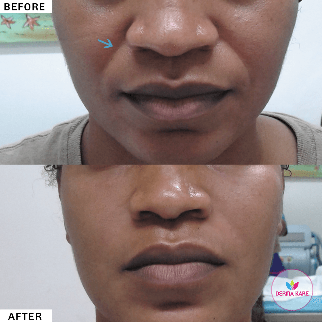 Fillers image
