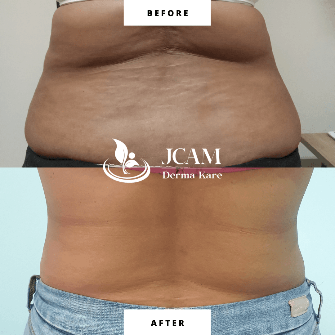 Mesotherapy