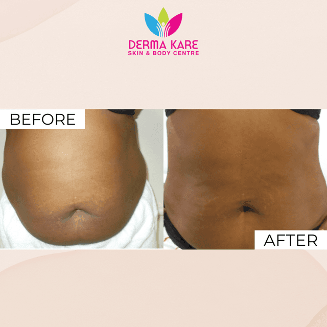 Natural Weight Loss for Stubborn Belly Fat in Jamaica