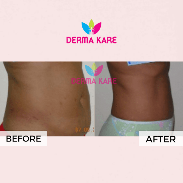 Mesotherapy results picture 4