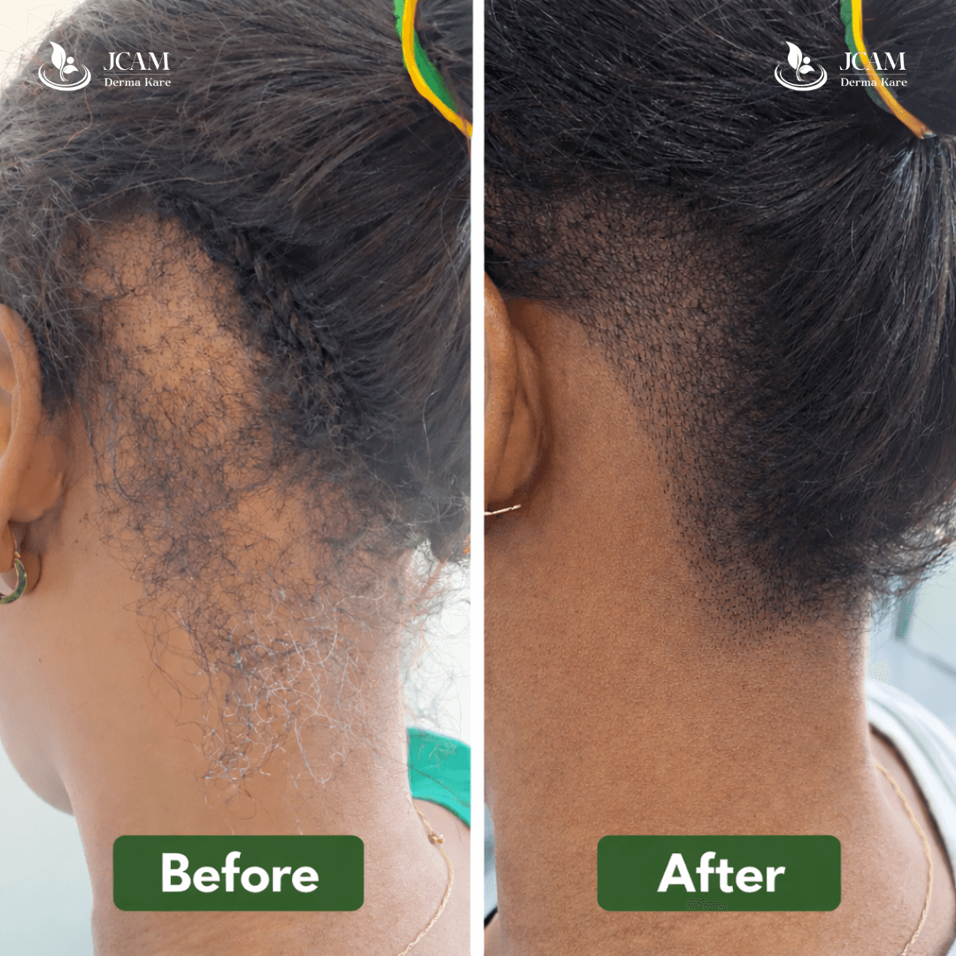 PRP Hair Loss Results